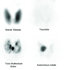 thyroid scan